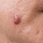 treatment for pimples 